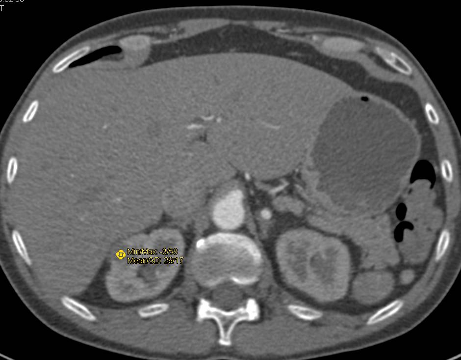 1 cm Papillary Renal Cell Carcinoma - CTisus CT Scan