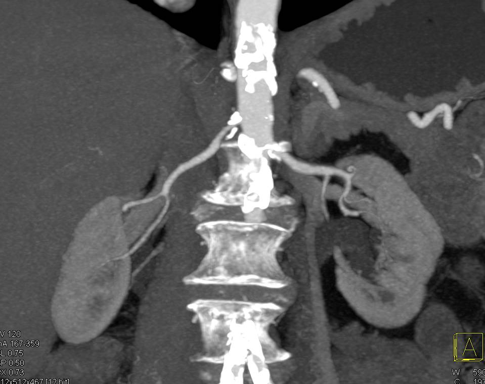 Critical Stenosis of Right Renal Artery - CTisus CT Scan