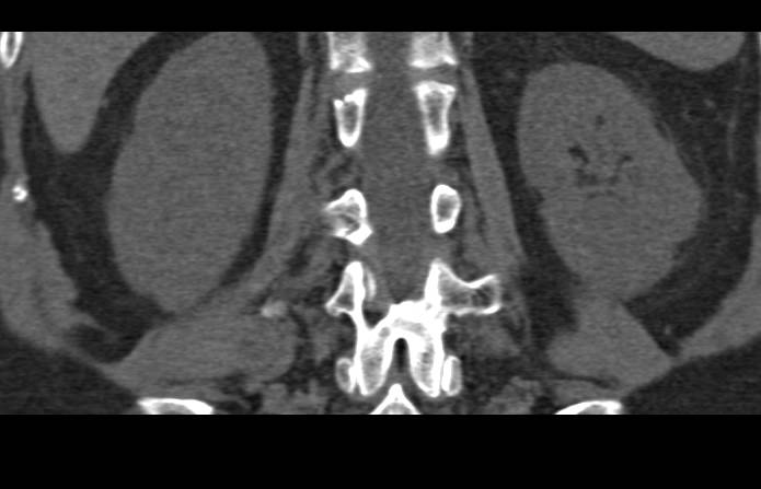 Transitional Cell Carcinoma Upper Pole Left Kidney - CTisus CT Scan