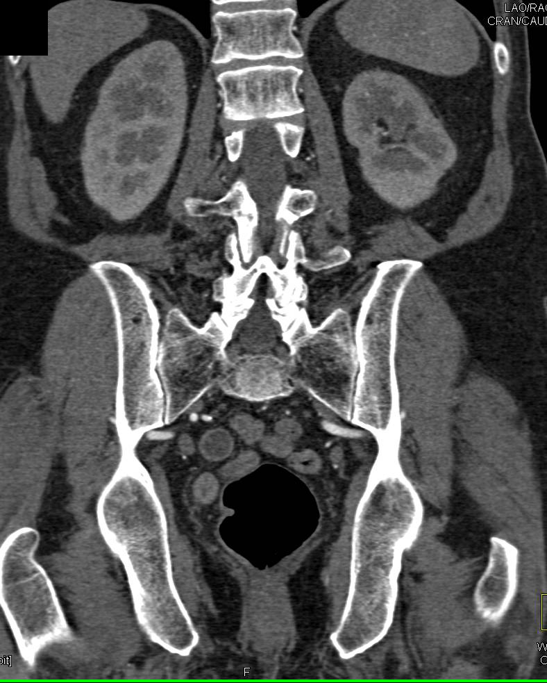 Minimal Scarring Right Kidney - CTisus CT Scan