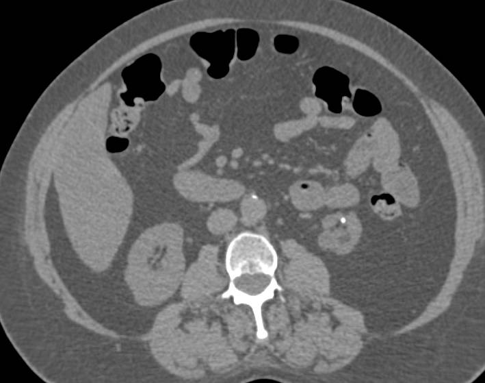 Bilateral Renal calculi with Scarring Lower Pole of Duplicated Left Collecting System - CTisus CT Scan