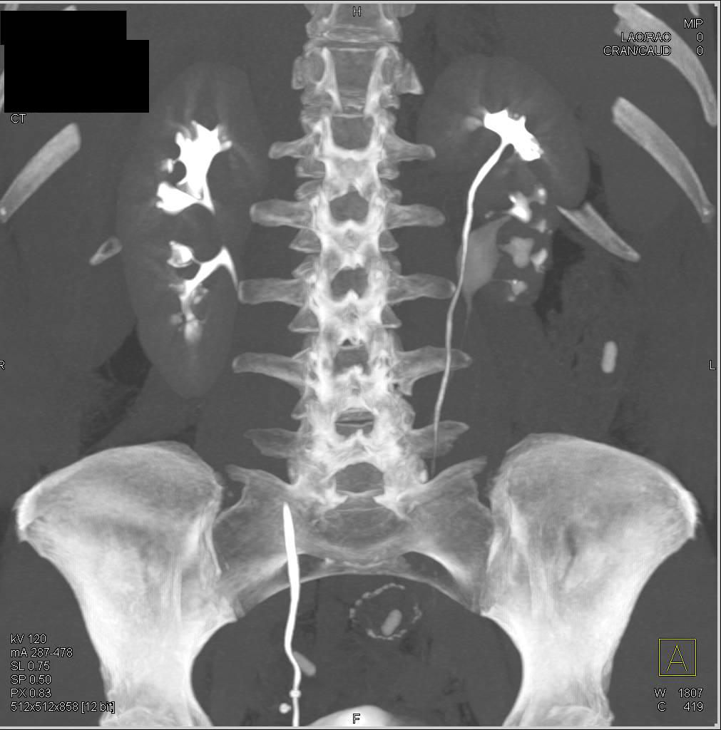 Bilateral Renal calculi with Scarring Lower Pole of Duplicated Left ...