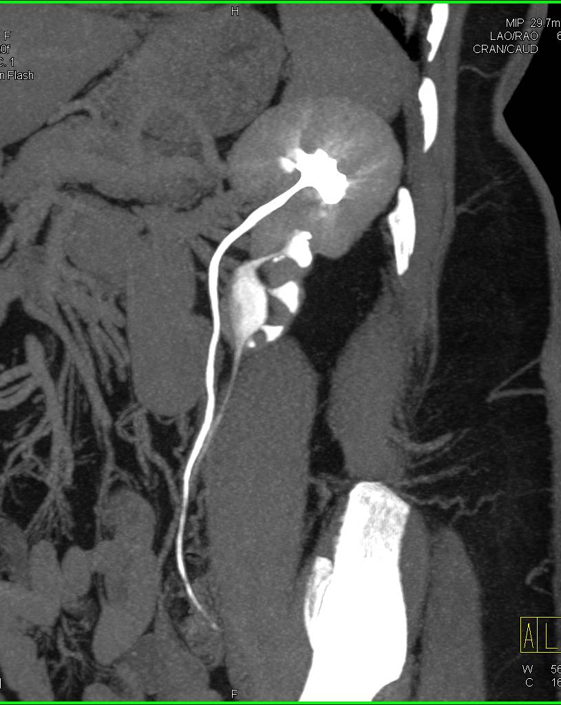 Duplicated Collecting System Left Kidney with Scarring of the Lower Pole Moiety - CTisus CT Scan
