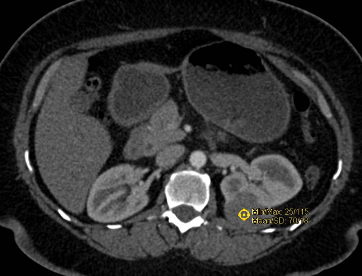 Papillary Renal Cell Carcinoma Left Kidney - CTisus CT Scan