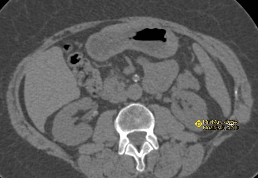 Low Grade Papillary Carcinoma Left Kidney - CTisus CT Scan