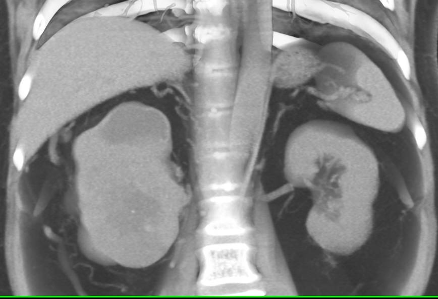 Vascular Renal Cell Carcinoma with Extensive Collaterals in Perirenal Space - CTisus CT Scan