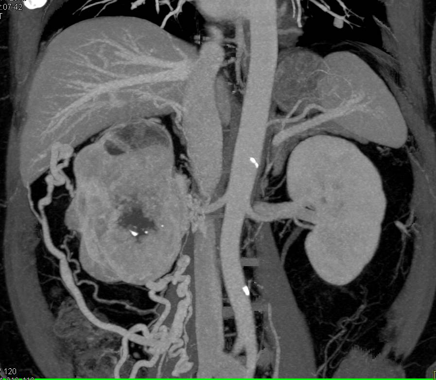 Renal Cell Carcinoma with Perirenal Collaterals - CTisus CT Scan