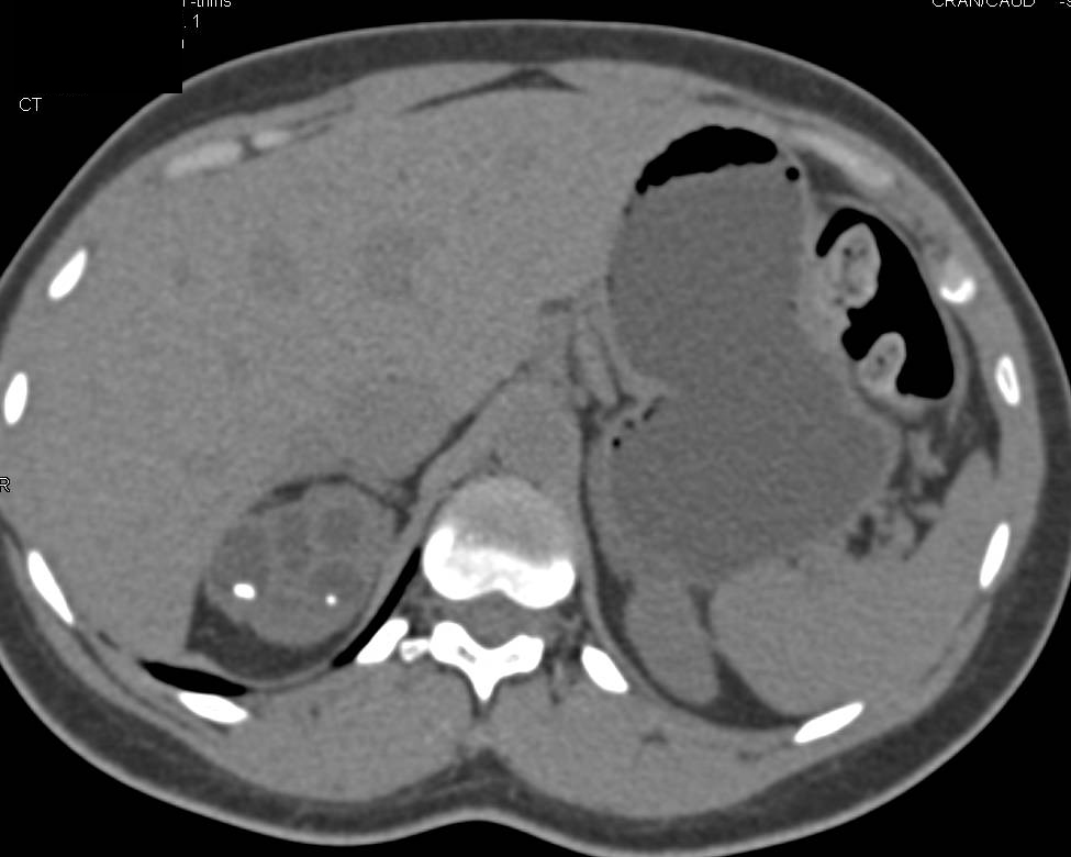 Dilated Calyces with Calculi Right Kidney. Could be a Sequelae of Infection - CTisus CT Scan