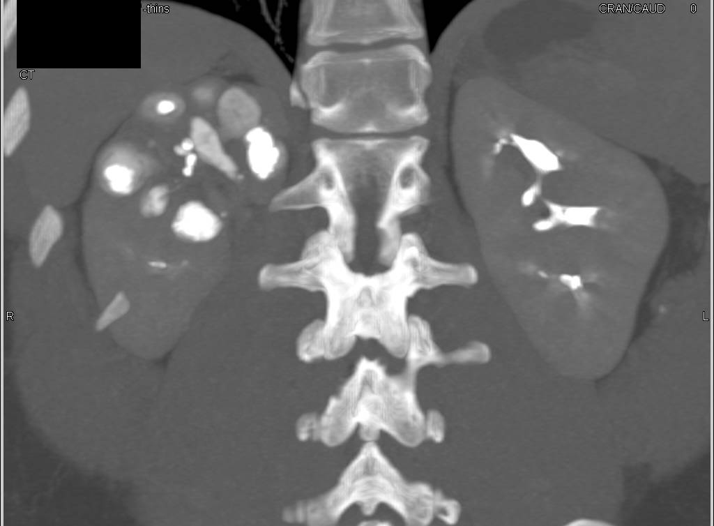 Dilated Calyces with Renal Calculi and Thinning of Cortex - CTisus CT Scan