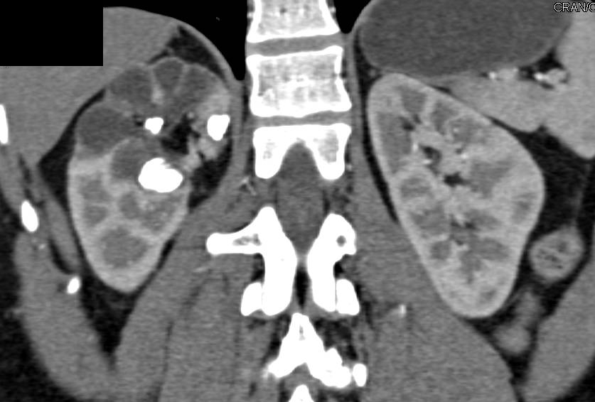 Parechymal Renal Disease due to Renal Calculi with Subsequent Dilated Calyces and Loss of Cortex - CTisus CT Scan