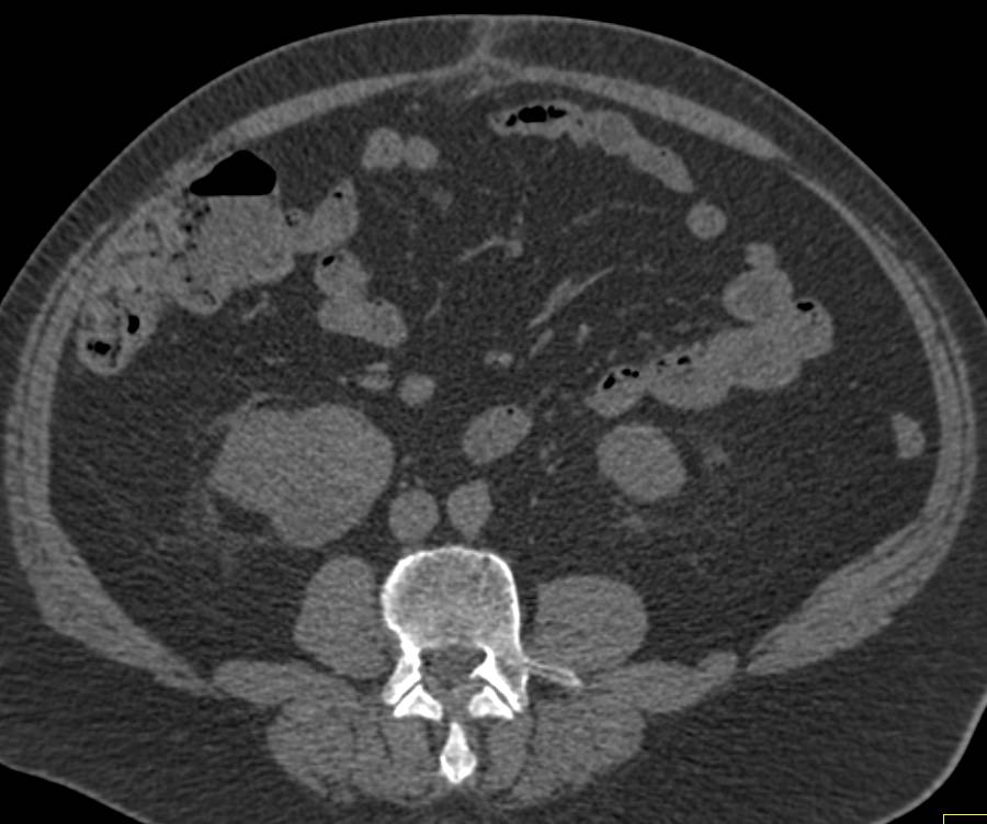 Papillary Renal cell Carcinoma Right Kidney - CTisus CT Scan