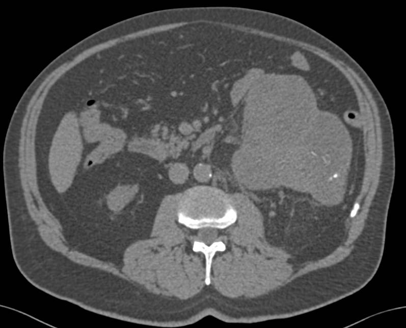 Renal Cell Carcinoma with Dystrophic Calcification - CTisus CT Scan