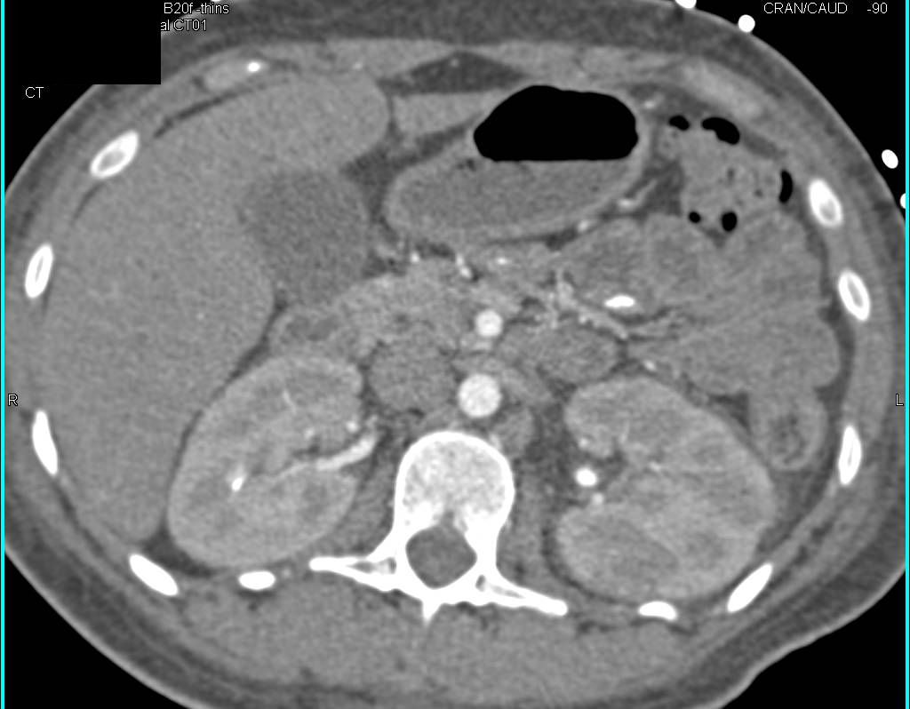 Acute Pyelonephritis Left Kidney - CTisus CT Scan