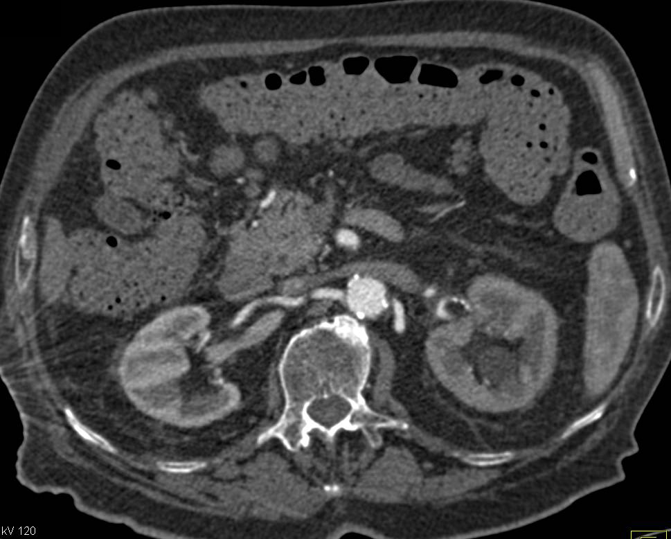 Delayed Enhancement of Left Kidney due to a Stone in the Distal Ureter - CTisus CT Scan