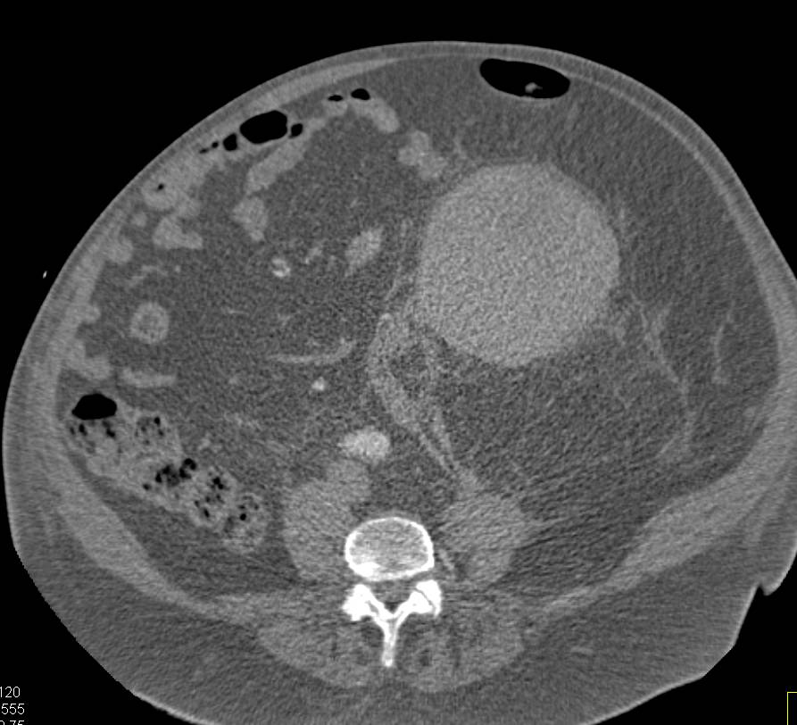 Spontaneous Renal Bleed due to Renal Cell Carcinoma - CTisus CT Scan