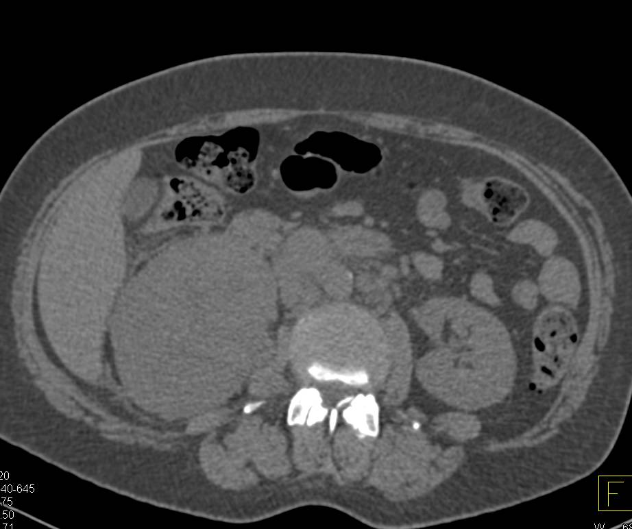 Renal Cell Carcinoma with Neovascularity and Para-aortic Adenopathy - CTisus CT Scan