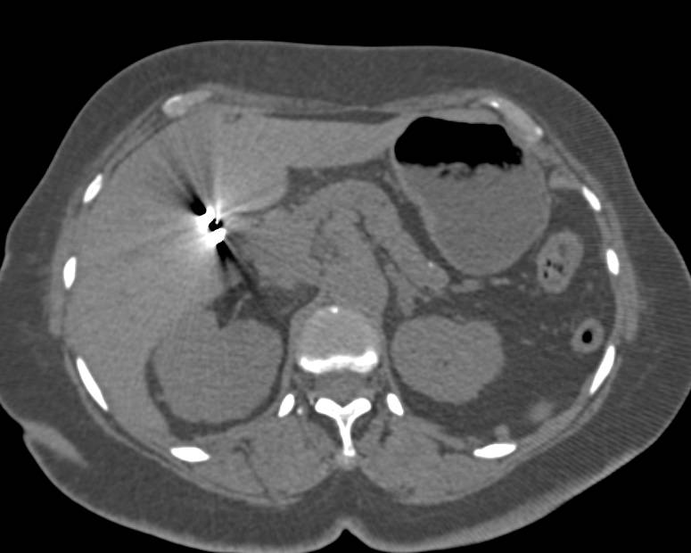 Bosniak I and II Renal Cysts - CTisus CT Scan