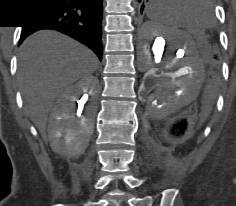 Transitional Cell Carcinoma of the Left Kidney - CTisus CT Scan