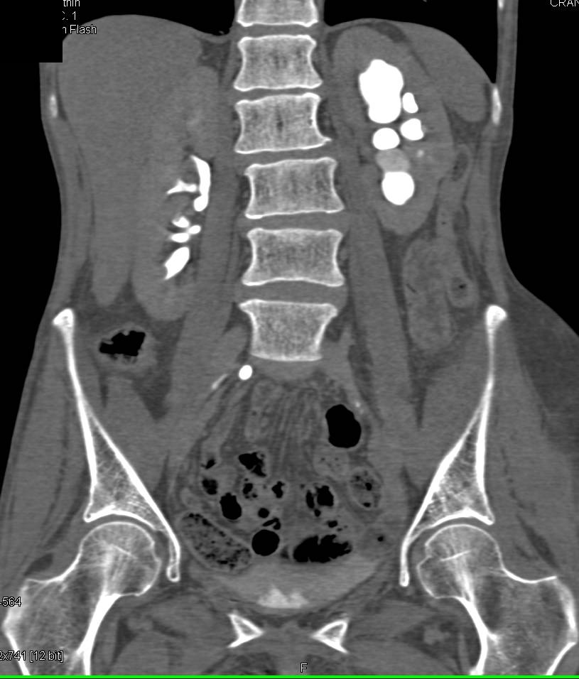 Left Hydronephrosis due to Ureteropelvic Junction (UPJ) Obstruction - CTisus CT Scan