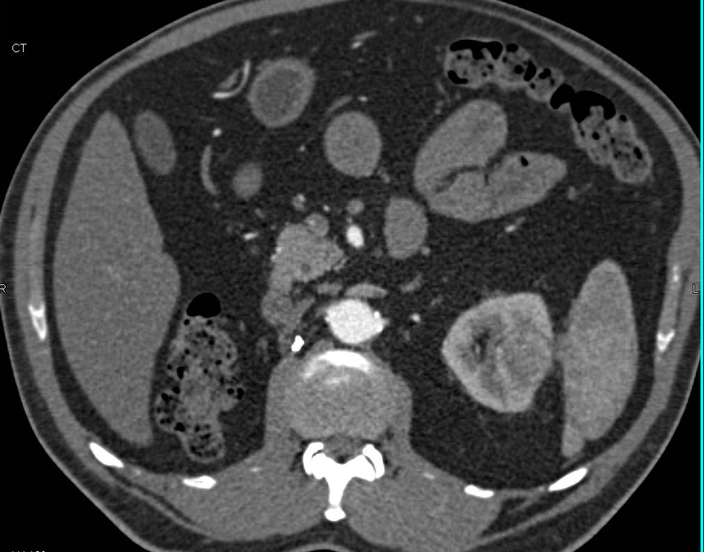 Renal Cell carcinoma Arises in Left Kidney in Patient with a Right Nephrectomy for Renal Cell Carcinoma - CTisus CT Scan