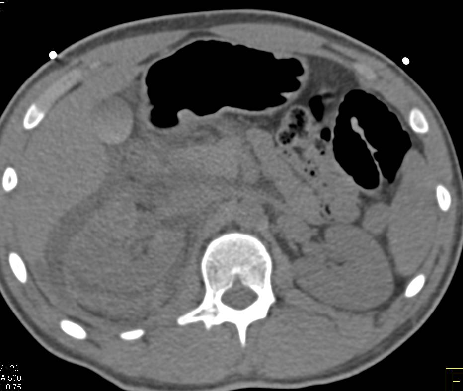 Renal Laceration with Perirenal Blood and Injury to Calyces on Delayed Phase Images - CTisus CT Scan