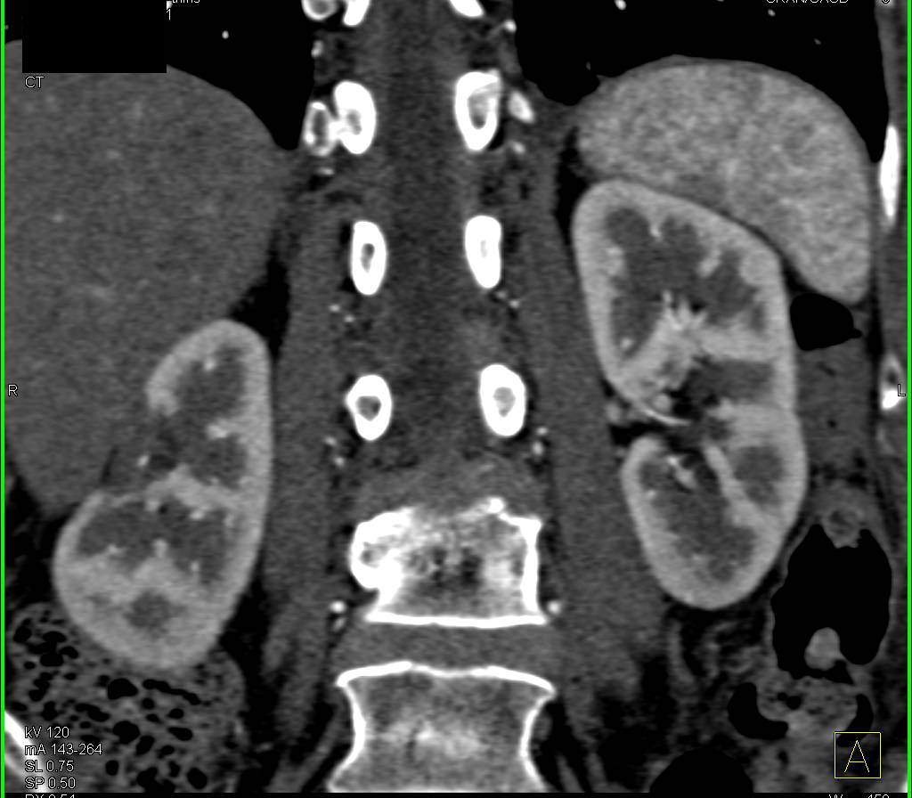 Subtle 1cm Left Renal Cell Carcinoma  Incidentally Detected During Follow-Up of Prior Ablation of Right Renal Mass - CTisus CT Scan