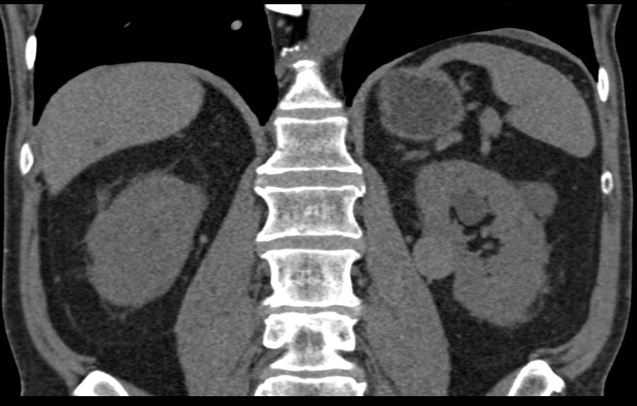 2 cm Right Renal Cell Carcinoma - CTisus CT Scan