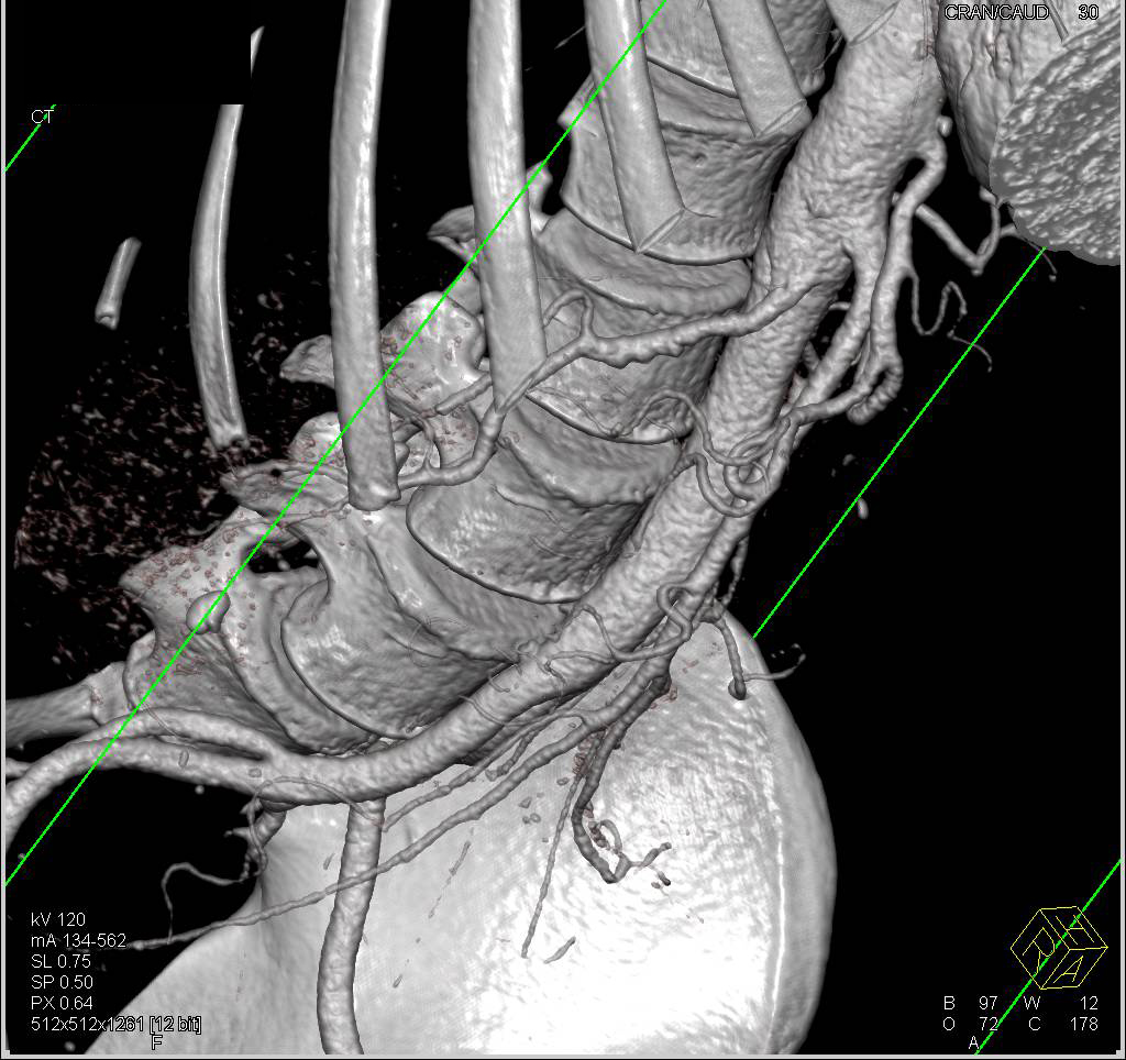 Fibromuscular Dysplasia (FMD) Right Renal Artery - CTisus CT Scan