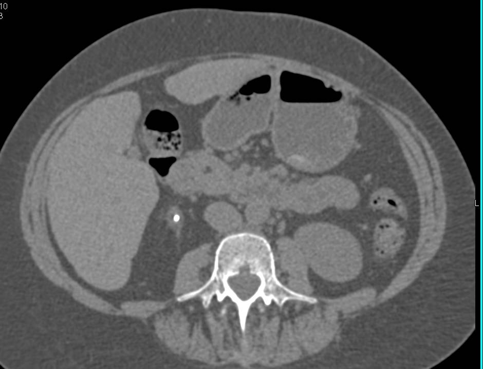 Transitional Cell Carcinoma Left Ureter with Stent in Place - CTisus CT Scan