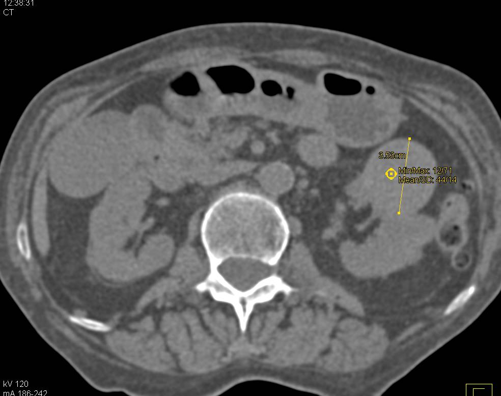 Multiple Left Renal Cell Carcinomas - CTisus CT Scan