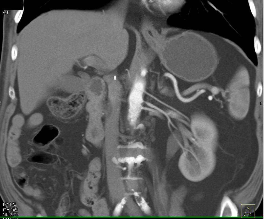 Three Left Renal Arteries wit Stenosis in Middle Artery - CTisus CT Scan