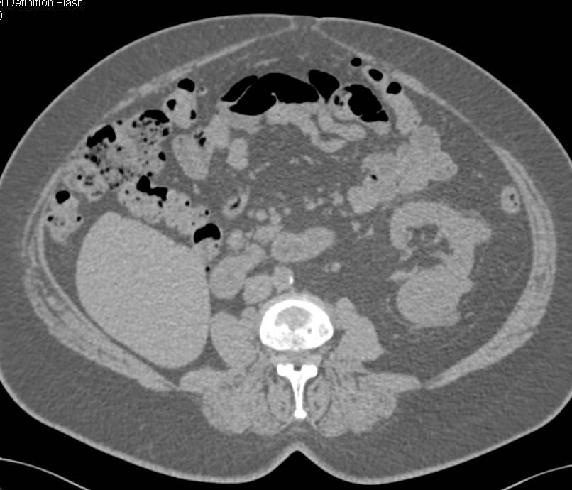 Right Nephrectomy for Renal Cell Carcinoma with Multiple Tumors in Contralateral Kidney - CTisus CT Scan