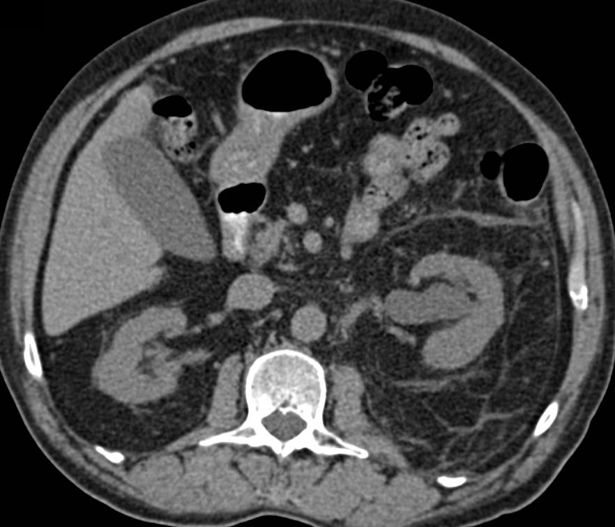 Obstruction Left ureter by Distal Stone with Stranding Around the Kidney - CTisus CT Scan