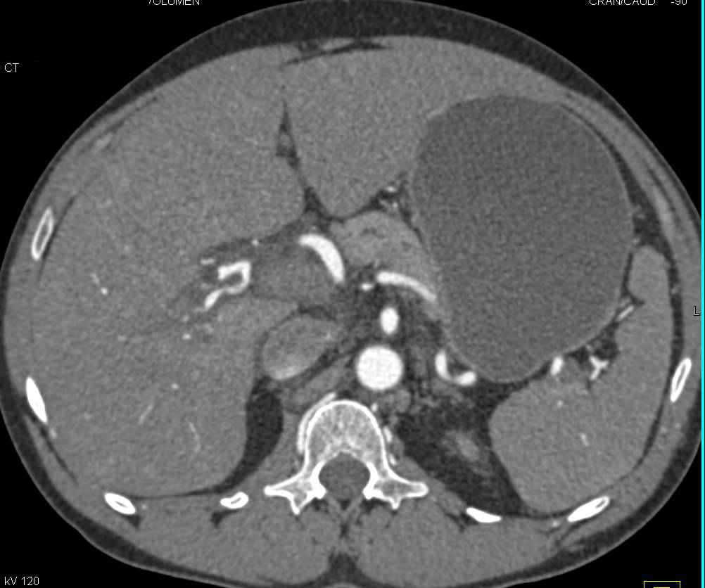 Vascular Mapping of a Renal Transplant to the Common Iliac Artery - CTisus CT Scan