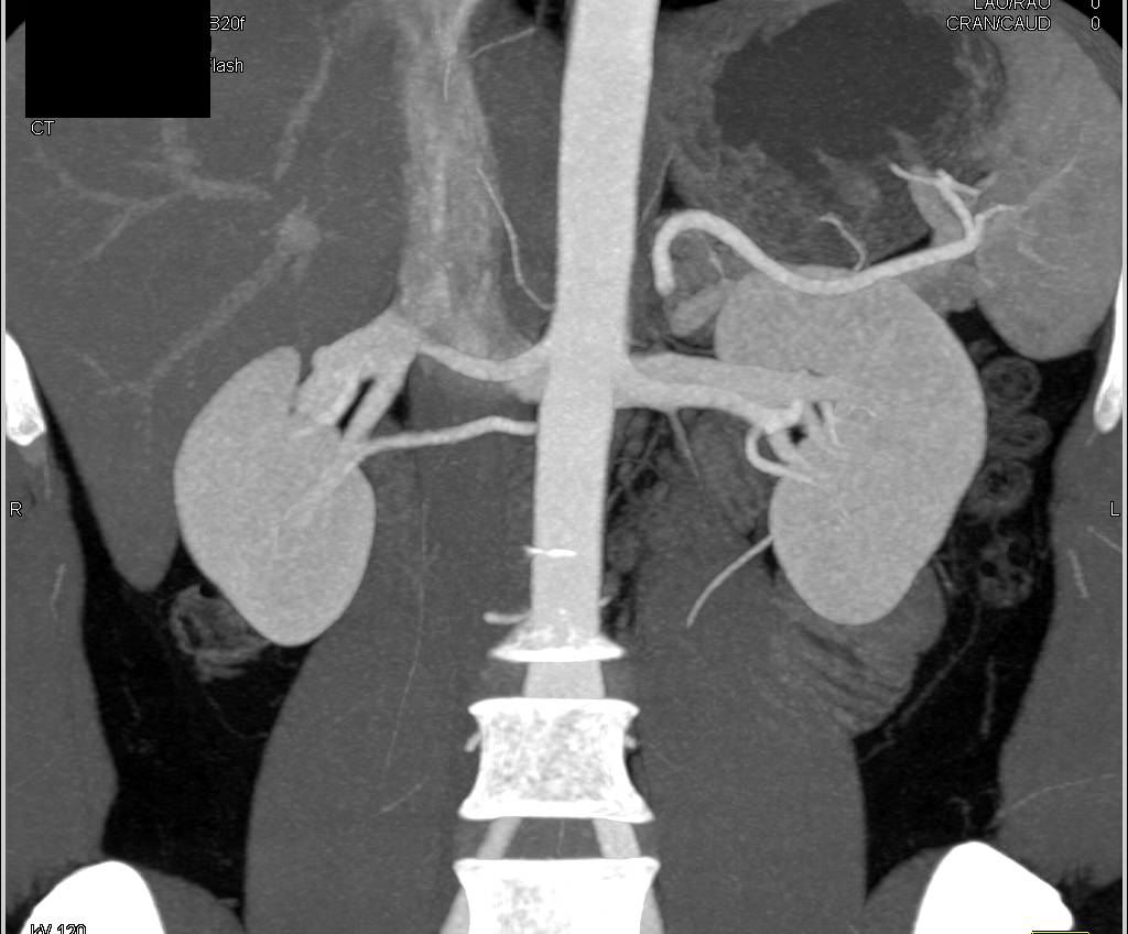 Two Right Renal Arteries - CTisus CT Scan