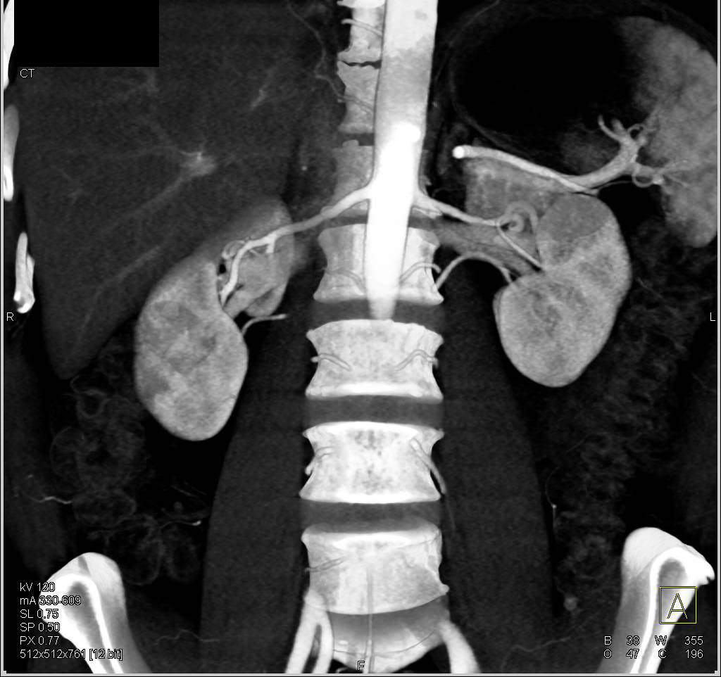 Renal Donor with 2 Arteries to Each Kidney - CTisus CT Scan