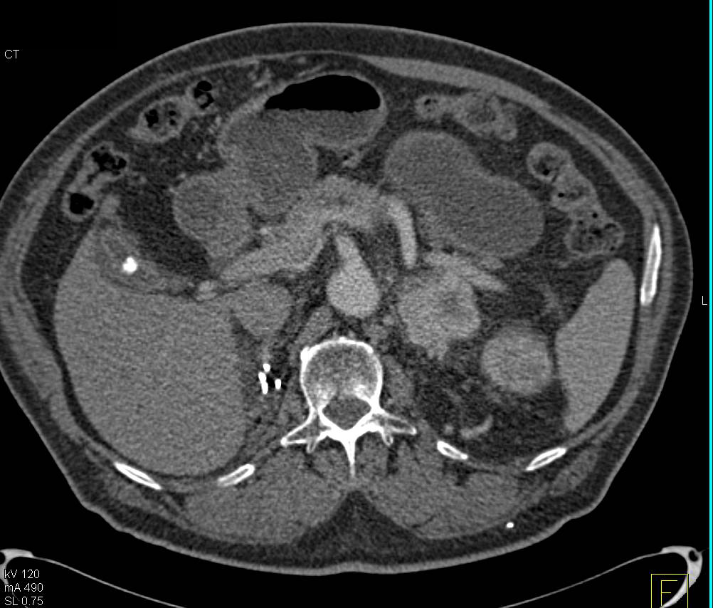 Right Renal Cell Carcinoma with Nephrectomy and Recurrence in Left Kidney and Left Adrenal Gland - CTisus CT Scan