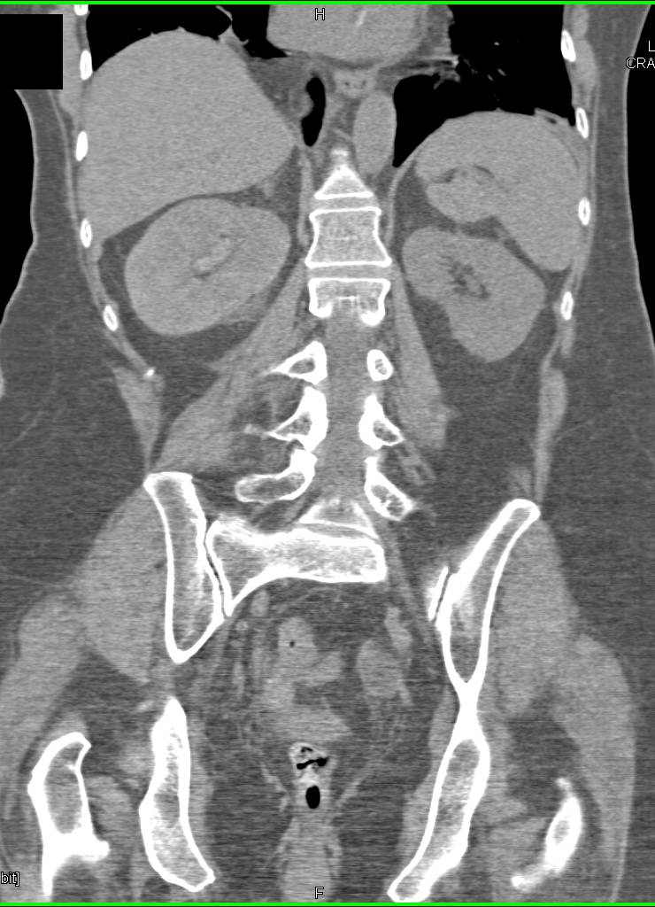 Transitional Cell Carcinoma Right Kidney - CTisus CT Scan