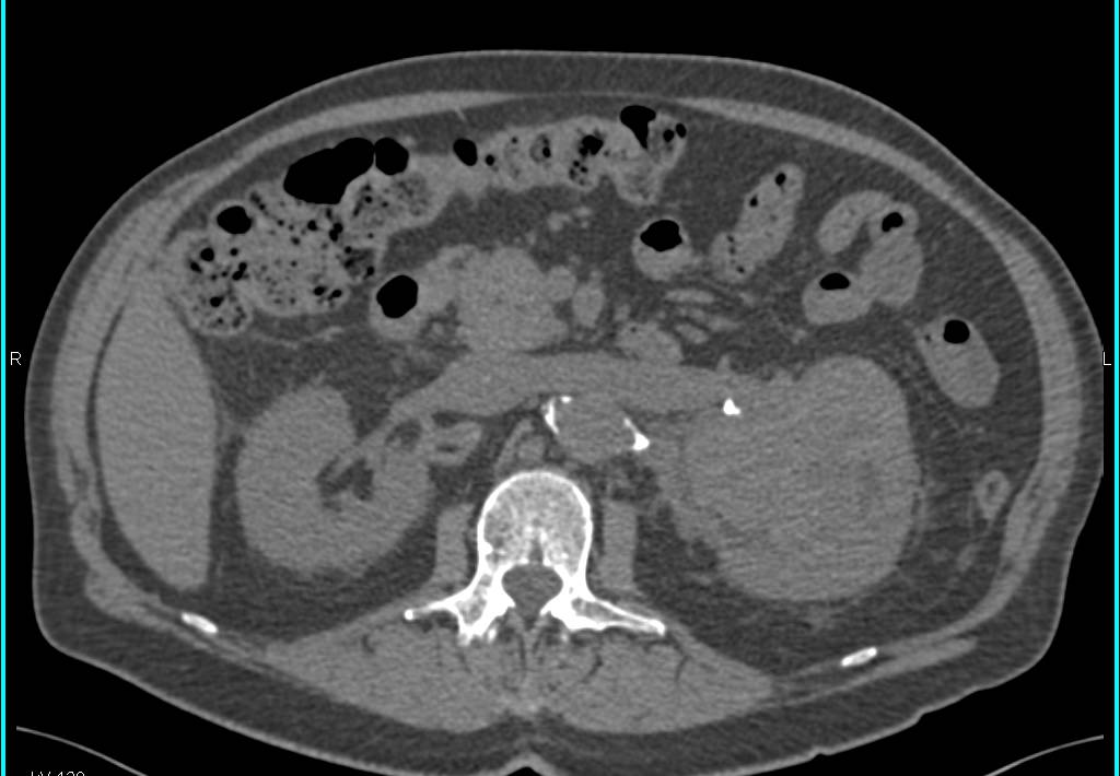 Clear Cell Renal Cell Carcinoma with Neovascularity and Renal Vein Extension - CTisus CT Scan