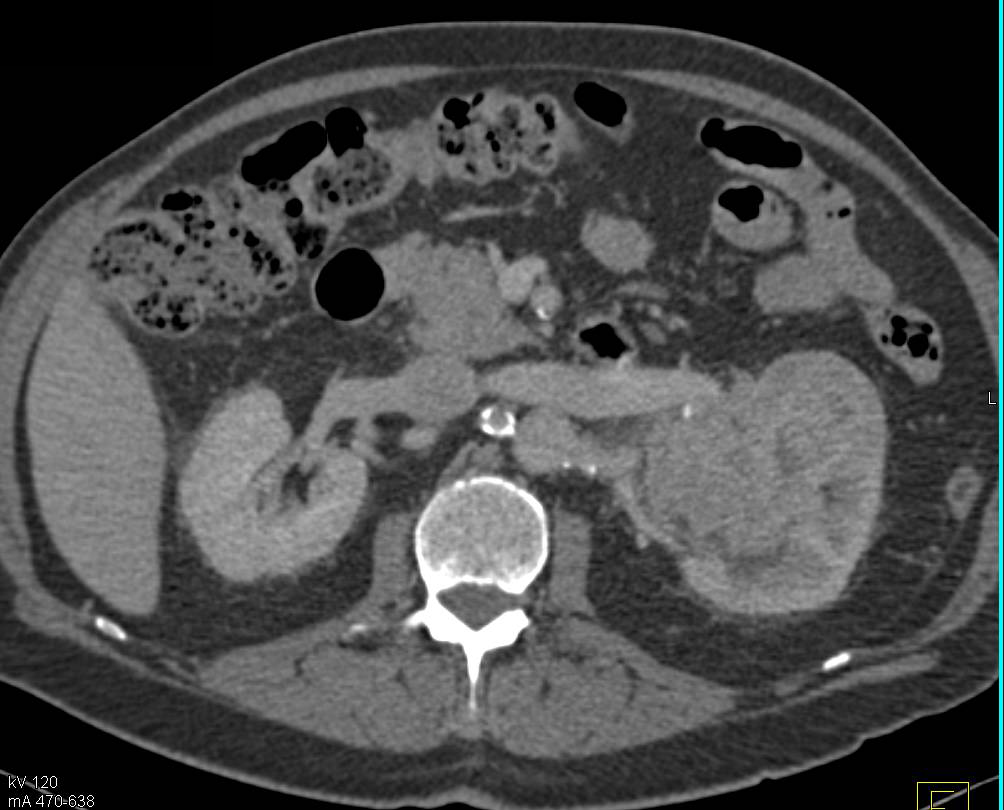 Renal Cell Carcinoma Invades the Renal Vein - CTisus CT Scan