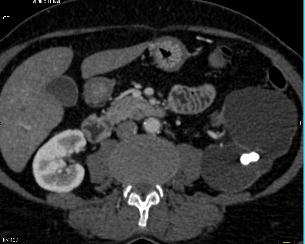 Renal Calcifications with Dilated Calyxes Lower Pole Left Kidney and Loss of Cortex - CTisus CT Scan