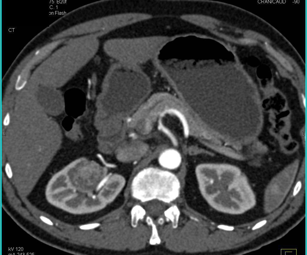 3 cm Right Renal Cell Carcinoma that is easy to miss Especially on Non-contrast Study - CTisus CT Scan