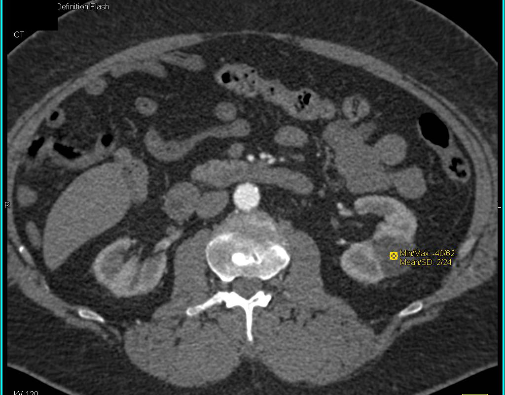 Complex Left Renal Cyst - CTisus CT Scan