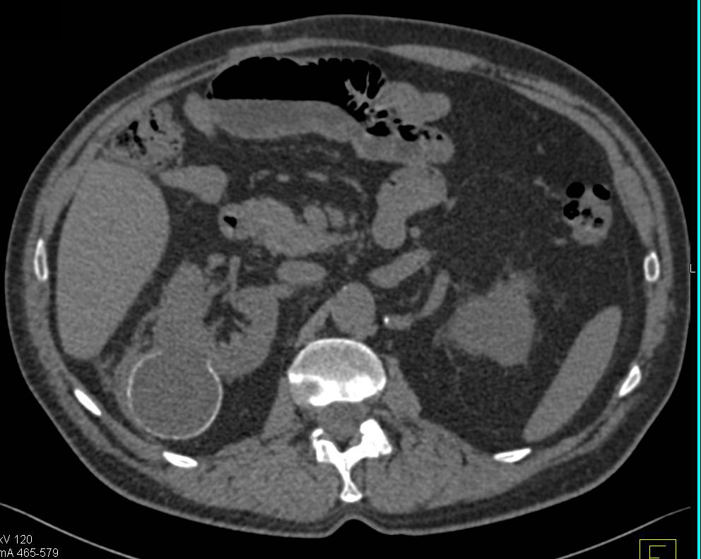 Bosniak 2F Cyst - CTisus CT Scan