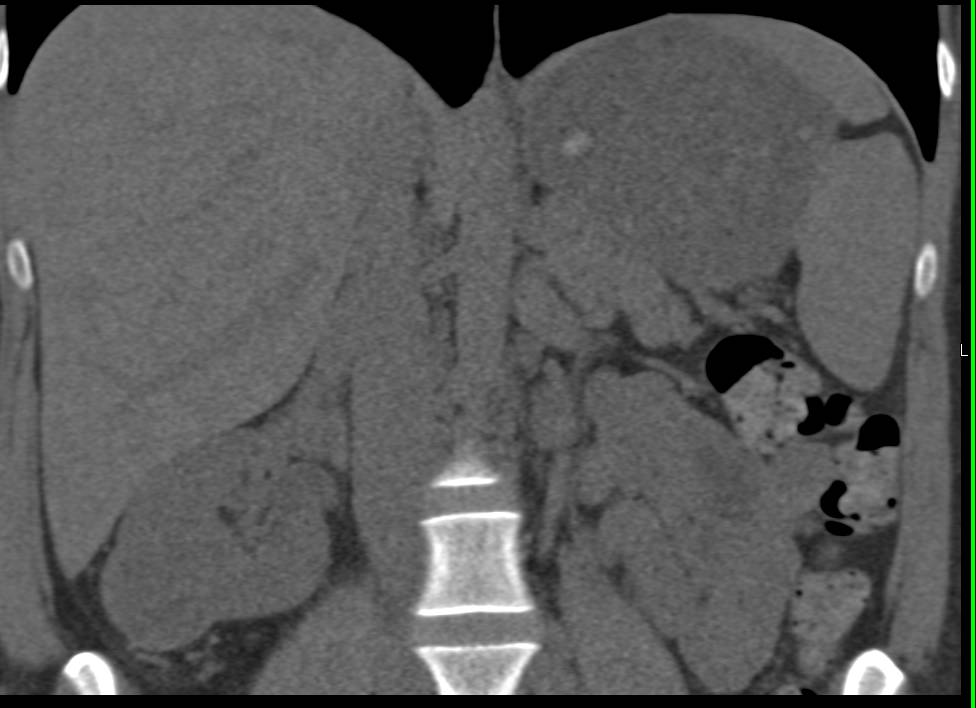 Clear Cell Renal Cell Carcinoma - CTisus CT Scan