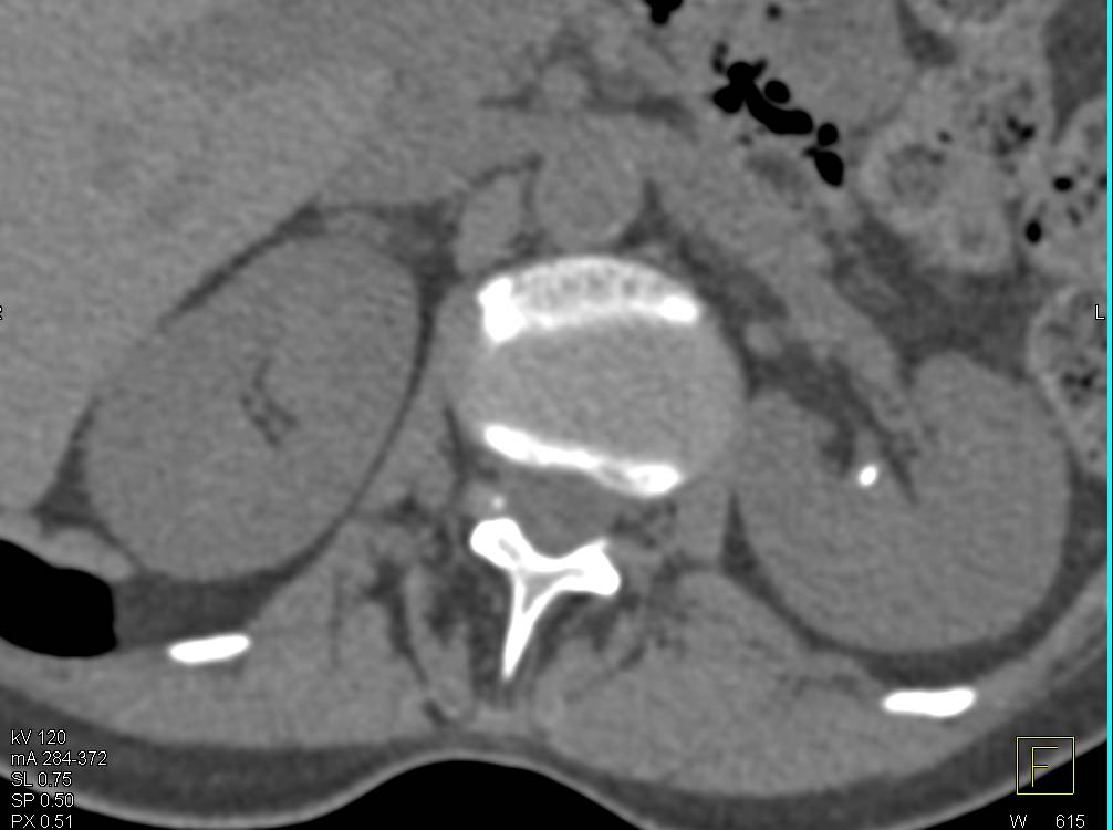 Renal Calculi with Medullary Sponge Kidney - CTisus CT Scan