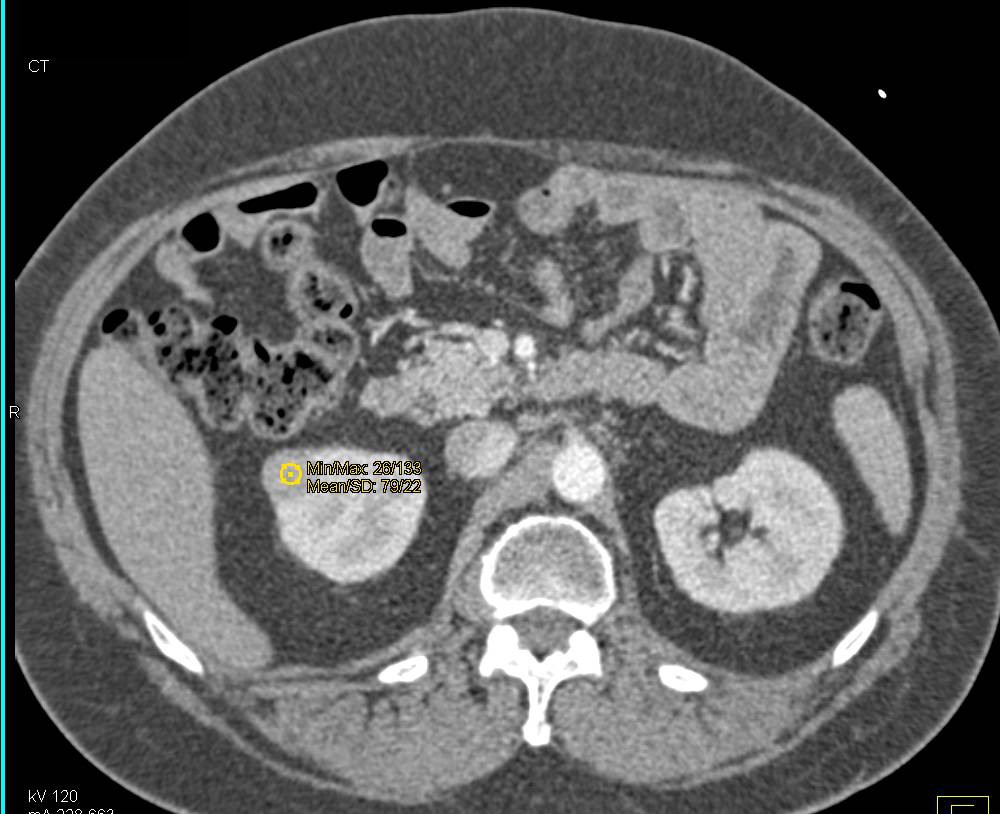 Papillary Renal Cell Carcinoma in a Patient with Prior Resection Lower Pole Right Kidney - CTisus CT Scan