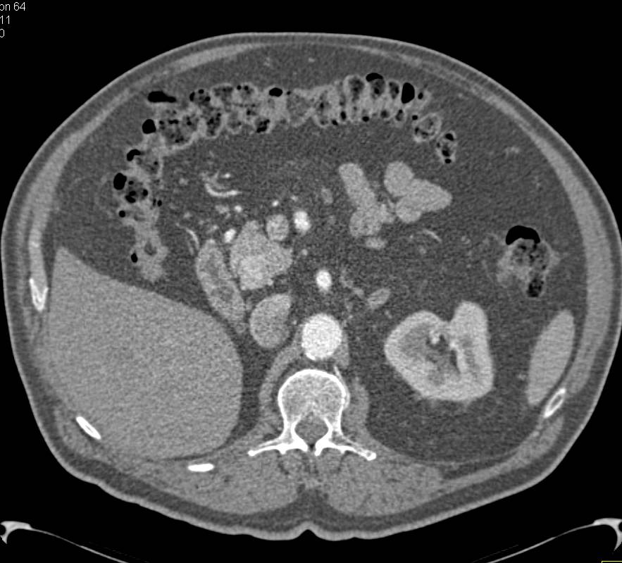 Renal Cell Carcinoma with Nephrectomy and Late Metastases to the Head of the Pancreas - CTisus CT Scan