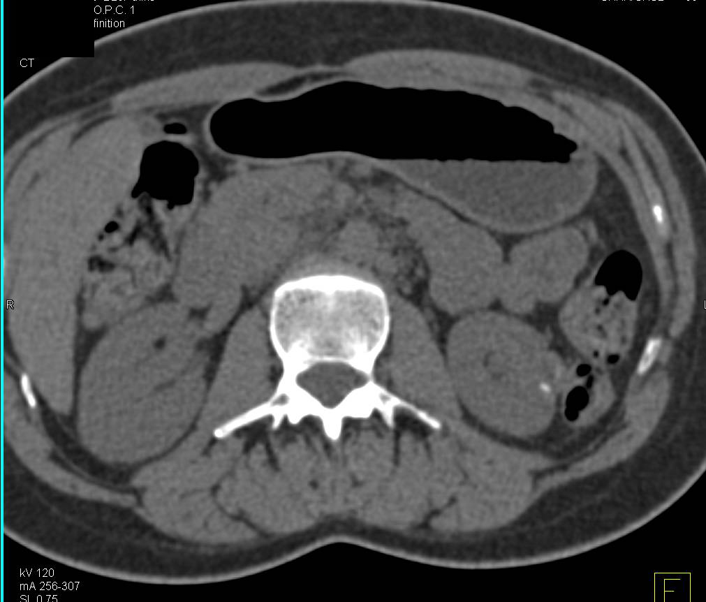 Bosniak Cyst II with Septation and Calcification - CTisus CT Scan