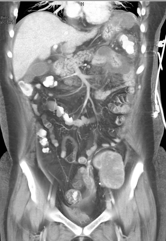 Failed Left Renal Transplant - CTisus CT Scan